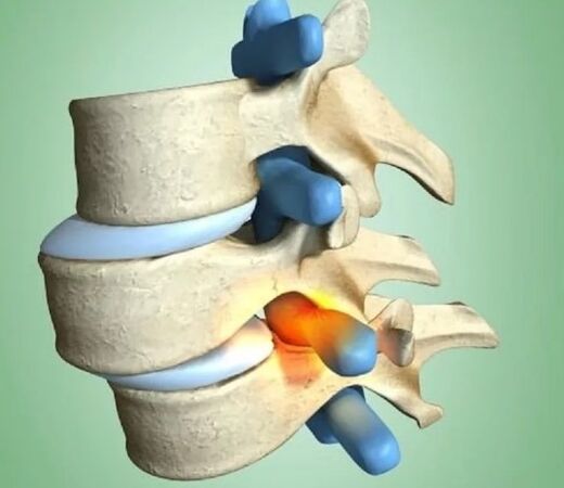 Мавқеи ноустувори vertebra