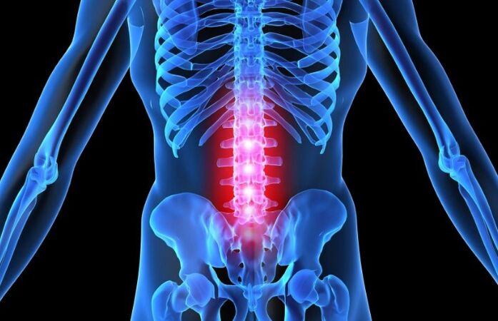 Остеохондрози минтақаи Lumbar